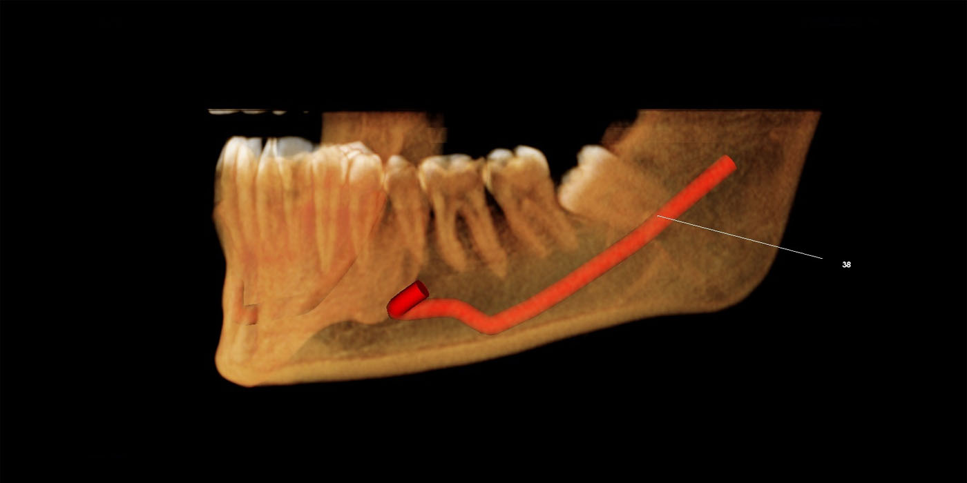 Mandible / Maxilla