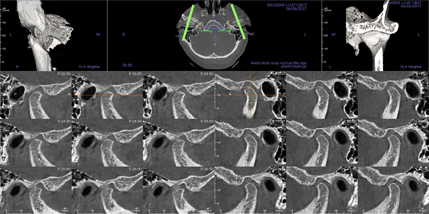 TMJ Scan